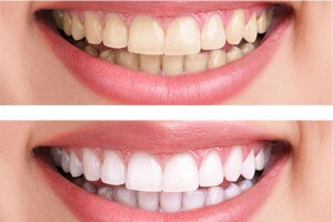 بهداشت و زیبایی دندان