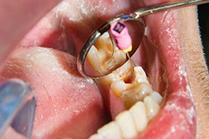 دیگر مراحل عصب‌کشی دندان