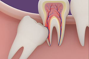 مشکلات ناشی از دندان عقل نهفته