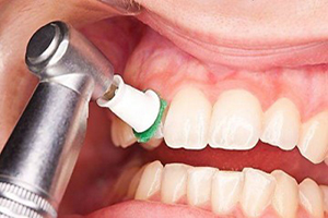 عواقب ناشی از جرم گرفتن دندان