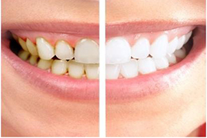 روش‌های جرم‌گیری دندان