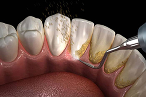 آیا جرم‌گیری دندان ضرر دارد؟