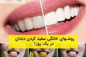 سفید شدن دندانهای زرد در یک روز