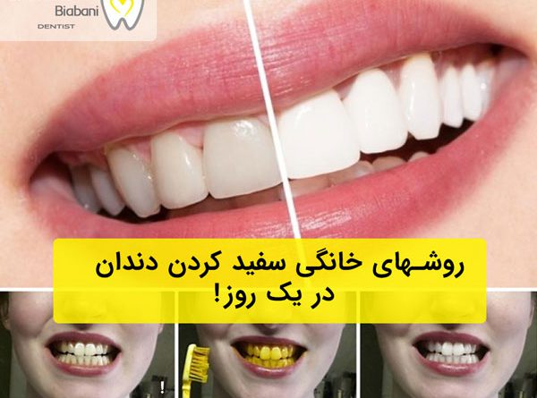سفید شدن دندانهای زرد در یک روز