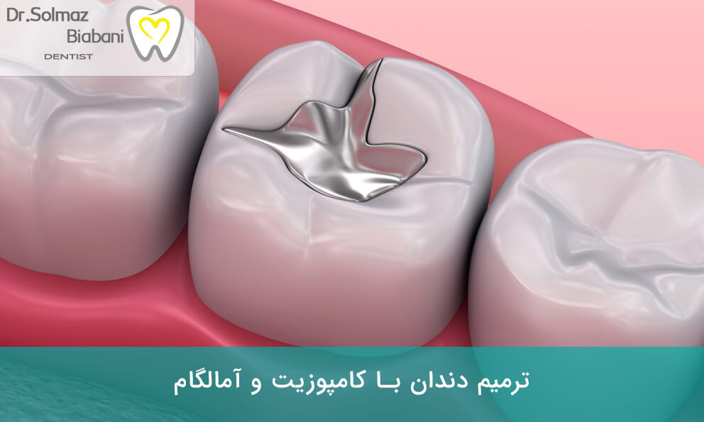 پر کردن دندان با مواد مختلف