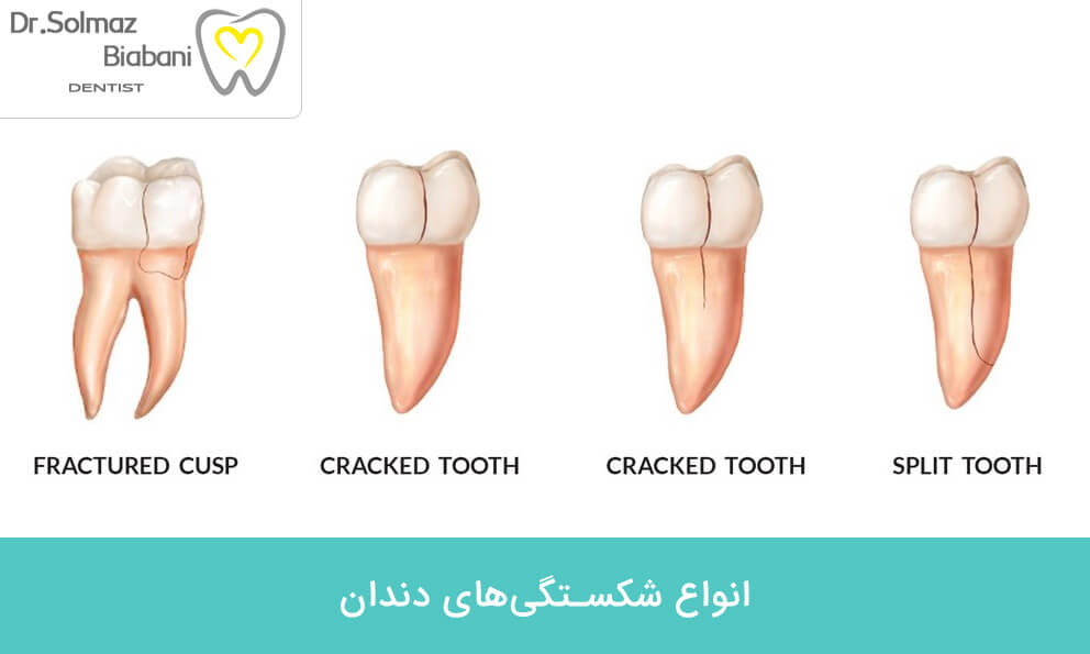 انواع شکستگی‌های دندان