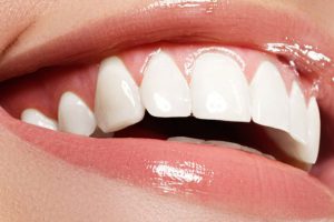 مراقبت‌های بعد از بلیچینگ دندان