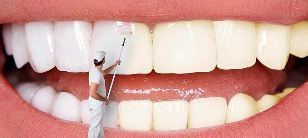 عوارض بلیچینگ دندان چیست و چگونه از آن پیشگیری کنیم؟ | drsolmazbiabani