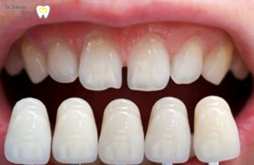 روکش دندان Minimal-Prep Veneers
