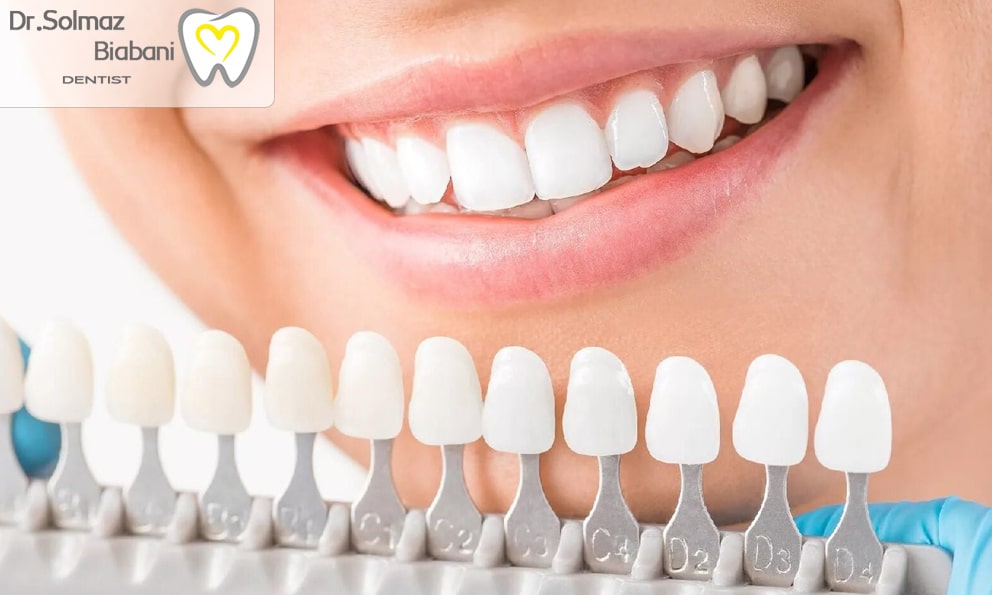 کاربرد روکش دندان چیست