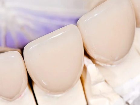 مزایای روکش پرسلن دندان