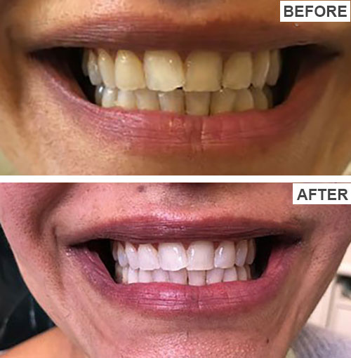 عکس قبل و بعد بلیچینگ دندان