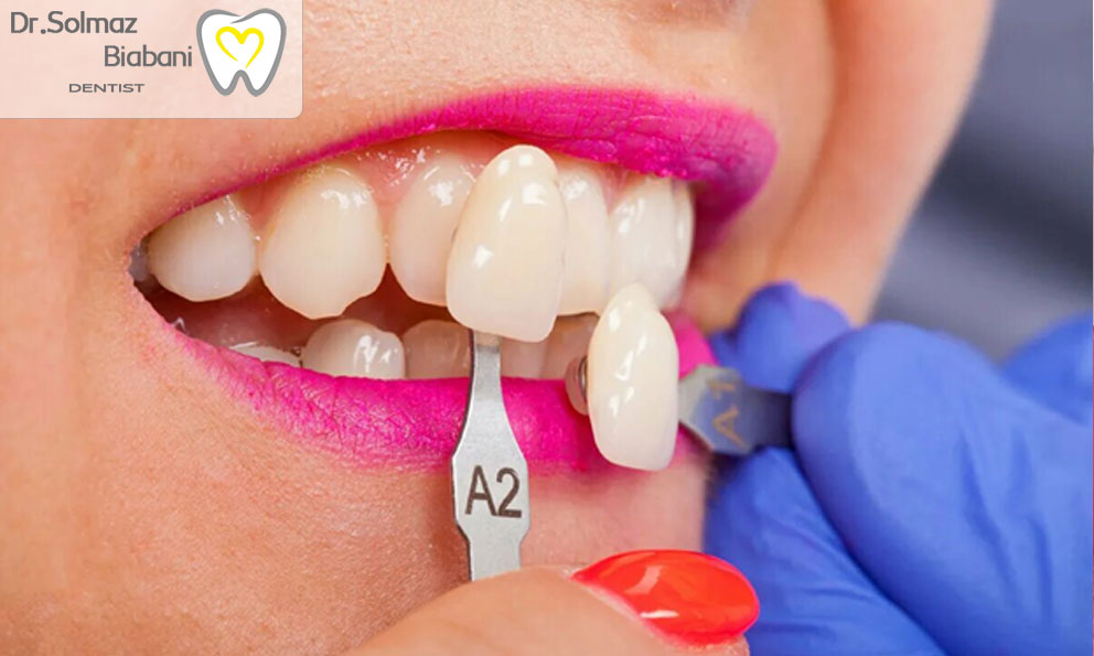 نحوه تعیین روکش پرسلن مناسب برای دندان