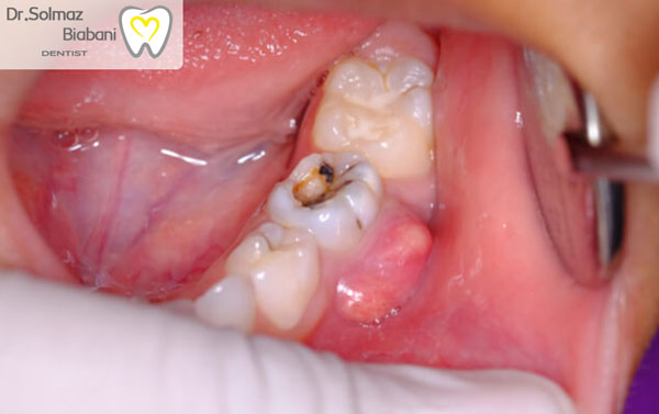 علائم عفونت دندان عصب کشی شده